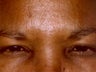 Botox