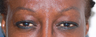 Botox for the frown lines