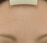 Forehead after Botox