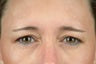 Botox