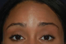 Botox to Treat Horizontal Forehead Lines