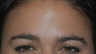 Botox to Treat Frown Lines and Vertical Lines Between Eyebrows