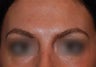 Botox