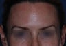 Botox