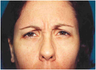 Chemical Brow Lift