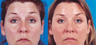 Botox