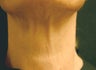 Botox Injections for Platisma Bands
