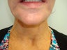 Botox