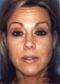 Botox