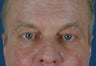 Man in 50's seek non-surgical facial rejuvention