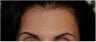 Botox