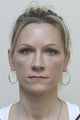 Botox and Restylane