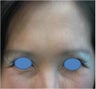 Botox