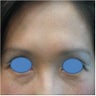 Botox