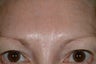 Brow asymmetry