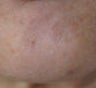 Botox for pebble chin