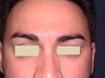 Botox