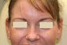 Botox