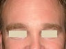 Botox