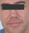 Botox between the eyes