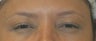 Botox Treatment