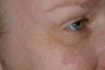 Non-surgical eye rejuvenation