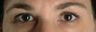 Botox