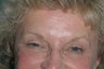 Crowsfeet treated with Botox Cosmetic
