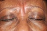 Botox for frown lines