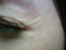 Botox Cosmetic for Crow's Feet wrinkles