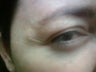 Botox Cosmetic, Crow's Feet
