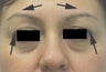 Botox Brow Lift