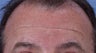 Botox to forehead