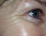 Botox to the crow's feet