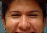 Botox Crow's feet