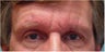 Botox frown lines