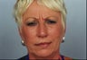 Botox Injection