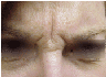 Botox