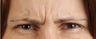 Botox Results