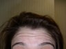 Botox