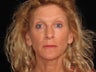 Botox and Restylane