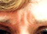 Botox