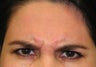 Botox