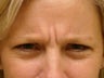 Botox Cosmetic