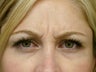 Botox Cosmetic
