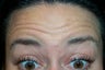 Botox Forehead