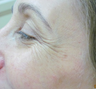 Botox for crow's feet