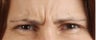 Botox