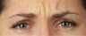 Botox