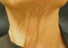 Botox